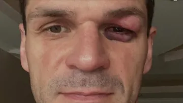 «Зробив укол в око, три уколи у сідницю, укол у вену»: колишній воротар Вересу ледь не втратив зір